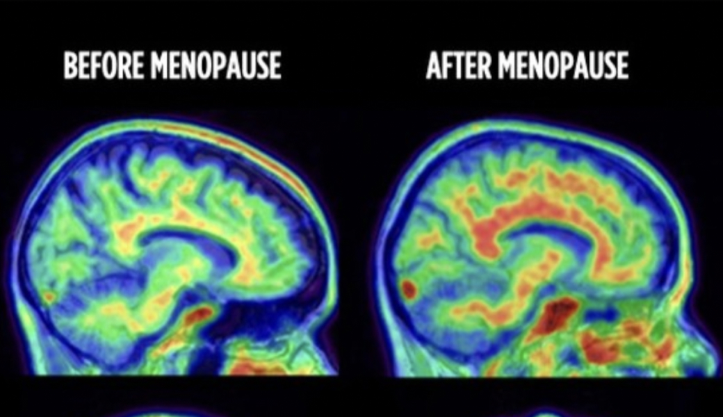 Image of a brain scan showing the brain prior to menopause and after menopause